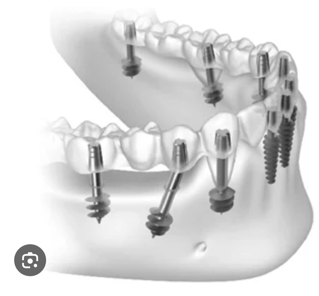 Dental Implants